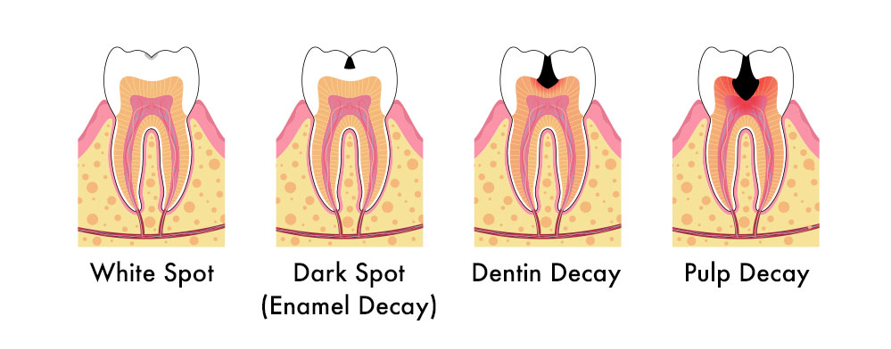 Stages of tooth decay from white spots to pulp involvement